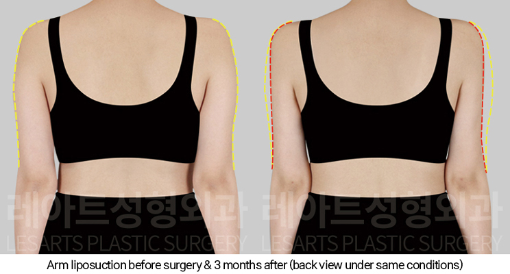 arm_liposuction_02_04_250110