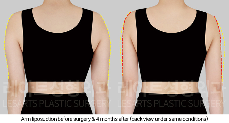 arm_liposuction_02_04_250205