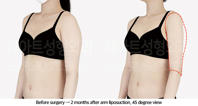arm_liposuction_02_05_240826