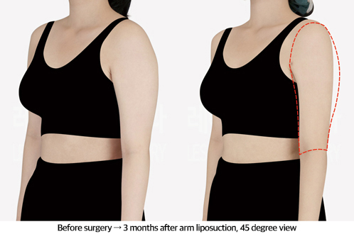 arm_liposuction_02_05_240913