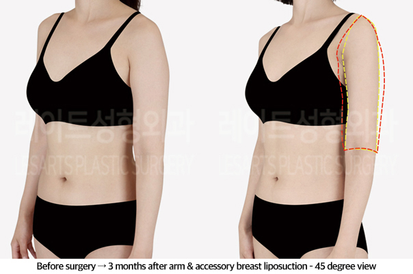 arm_liposuction_02_05_240920