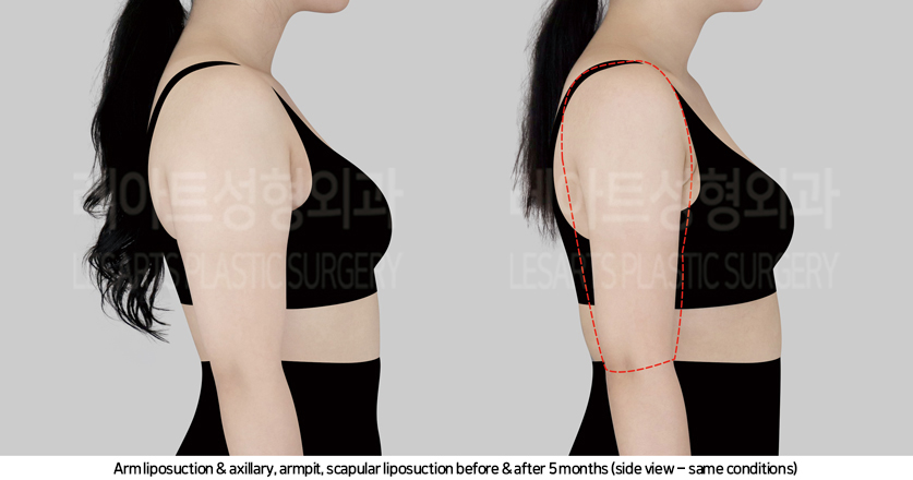 arm_liposuction_02_05_241017