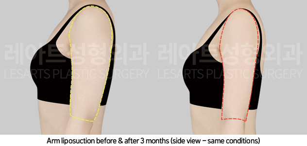 arm_liposuction_02_05_241101