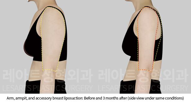 arm_liposuction_02_05_241128