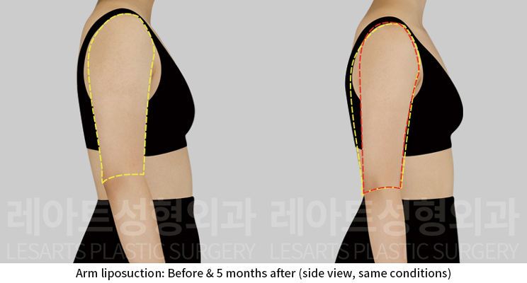 arm_liposuction_02_05_241224