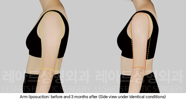 arm_liposuction_02_05_250102