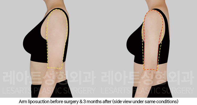 arm_liposuction_02_05_250107