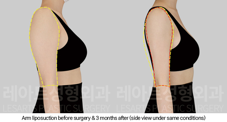 arm_liposuction_02_05_250110