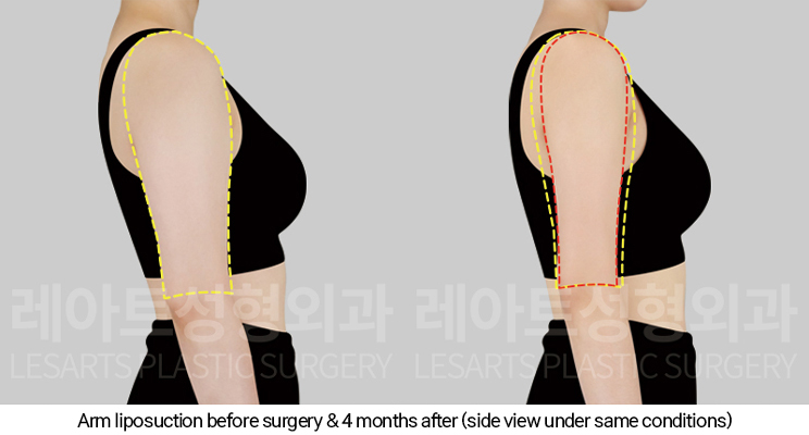 arm_liposuction_02_05_250205
