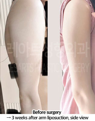 arm_liposuction_02_06_240826