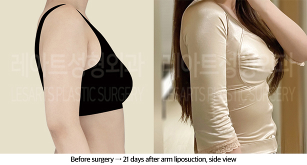 arm_liposuction_02_06_240911
