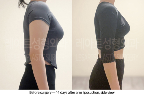 arm_liposuction_02_06_240913