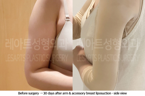 arm_liposuction_02_06_240920