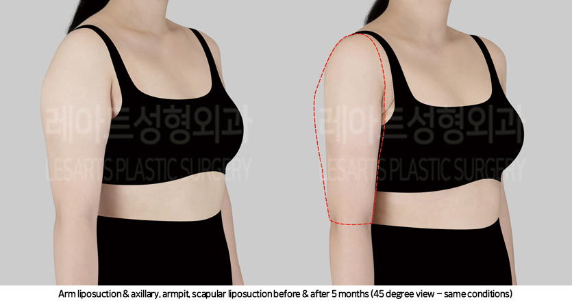 arm_liposuction_02_06_241017
