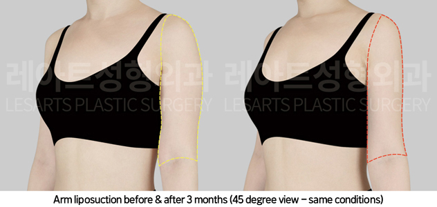 arm_liposuction_02_06_241101