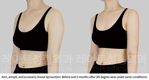 arm_liposuction_02_06_241128