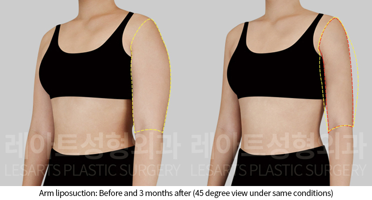 arm_liposuction_02_06_241202