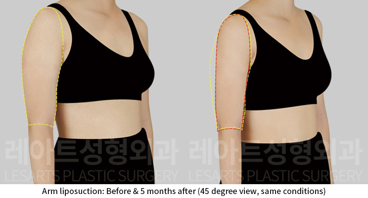 arm_liposuction_02_06_241224