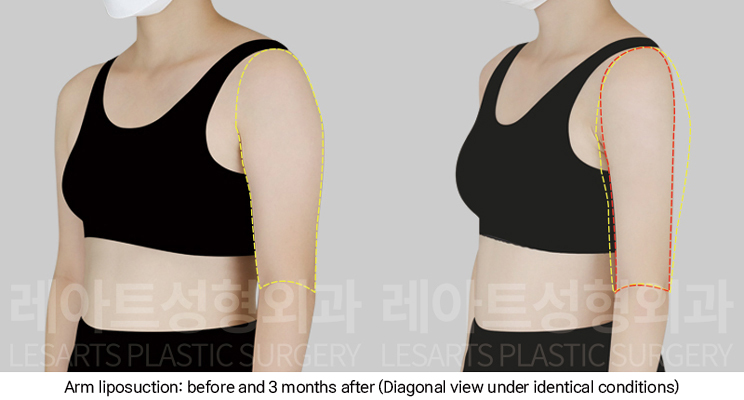 arm_liposuction_02_06_250102