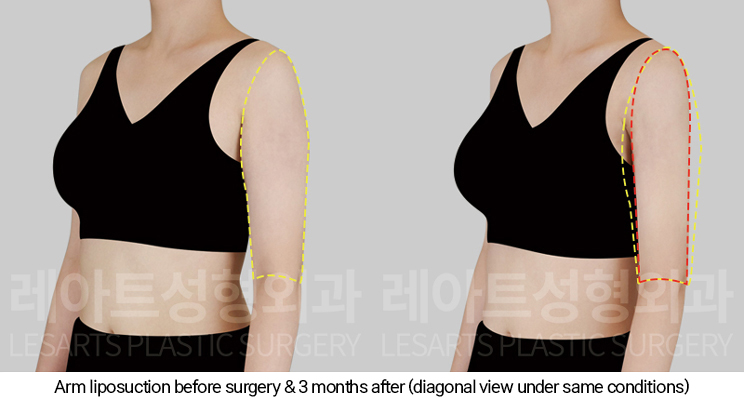 arm_liposuction_02_06_250107
