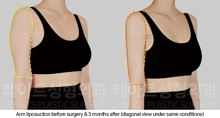 arm_liposuction_02_06_250110