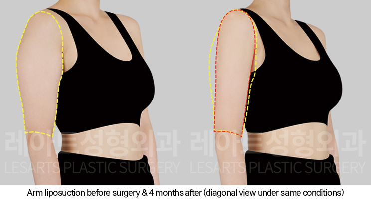 arm_liposuction_02_06_250205