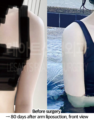 arm_liposuction_02_07_240826