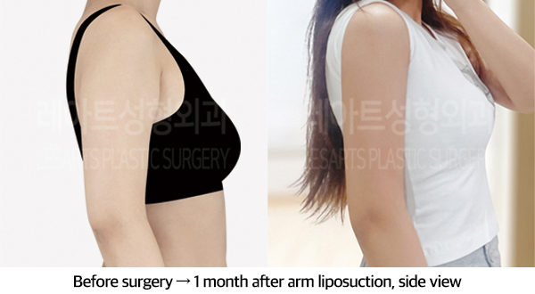 arm_liposuction_02_07_240911