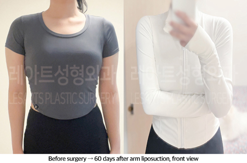arm_liposuction_02_07_240913