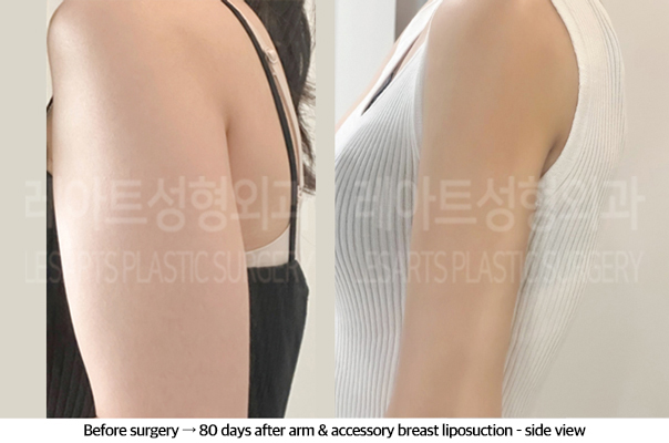 arm_liposuction_02_07_240920