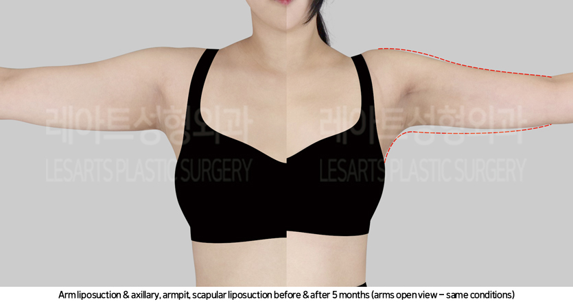arm_liposuction_02_07_241017