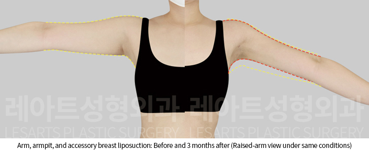 arm_liposuction_02_07_241128
