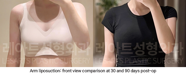 arm_liposuction_02_07_250102