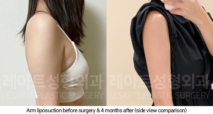 arm_liposuction_02_07_250110