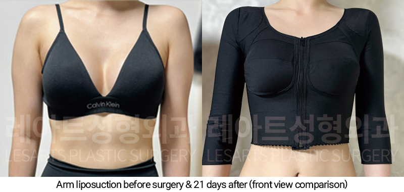 arm_liposuction_02_07_250205