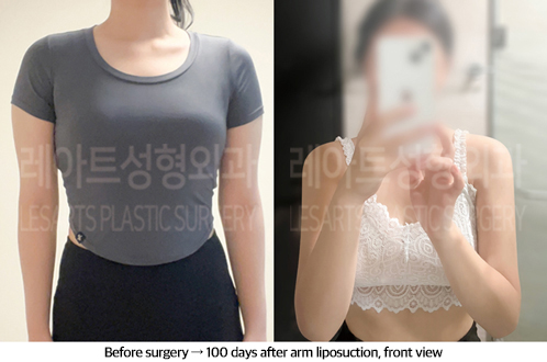 arm_liposuction_02_08_240913