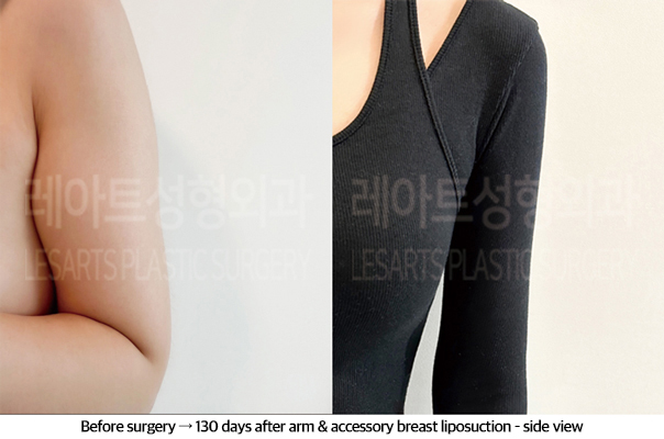 arm_liposuction_02_08_240920