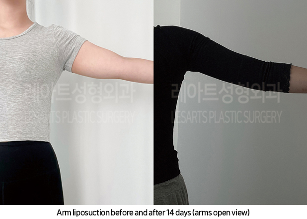 arm_liposuction_02_08_241017