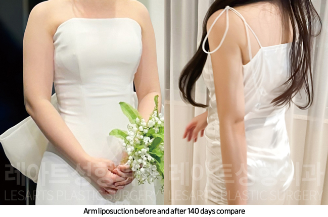 arm_liposuction_02_08_241101