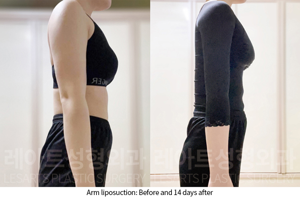 arm_liposuction_02_08_241128