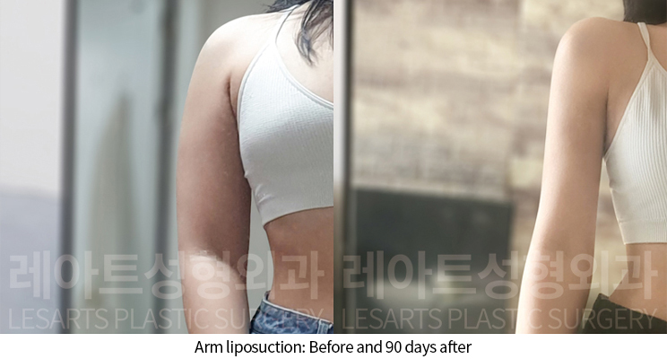 arm_liposuction_02_08_241202