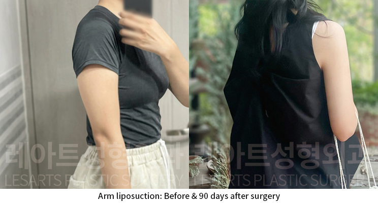 arm_liposuction_02_08_241224