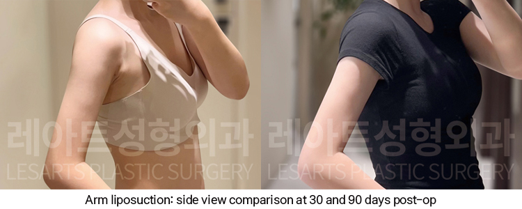 arm_liposuction_02_08_250102