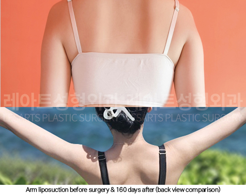 arm_liposuction_02_08_250107