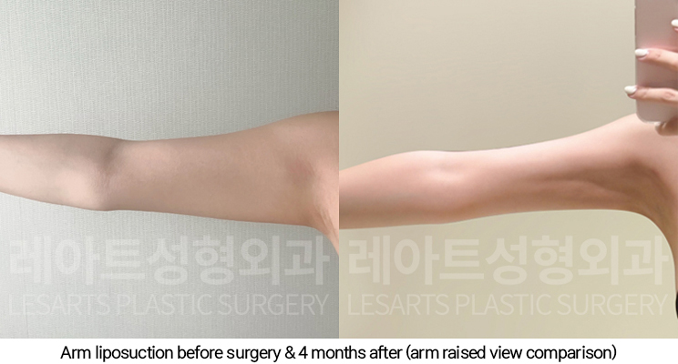 arm_liposuction_02_08_250110