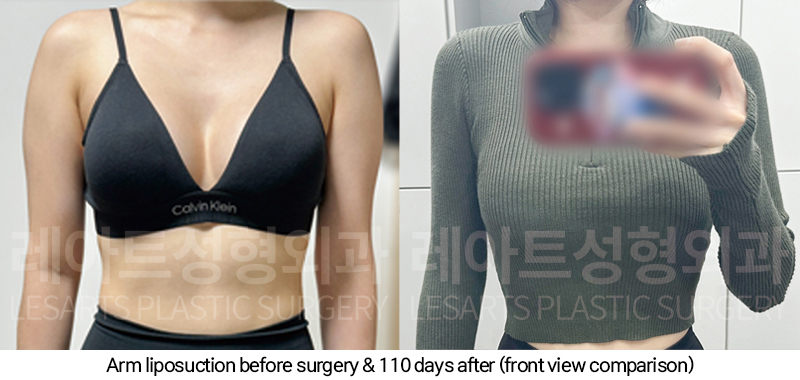 arm_liposuction_02_08_250205