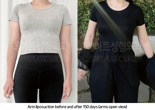 arm_liposuction_02_09_241017