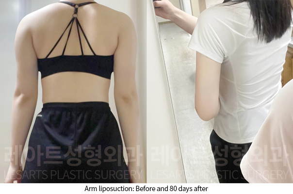 arm_liposuction_02_09_241128