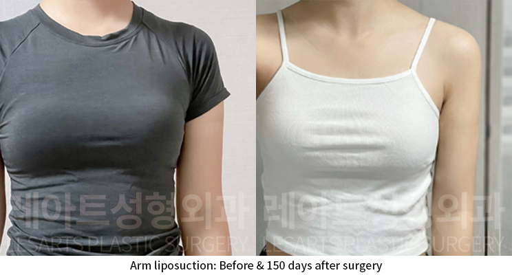 arm_liposuction_02_09_241224
