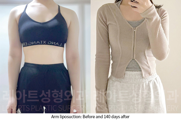 arm_liposuction_02_10_241128